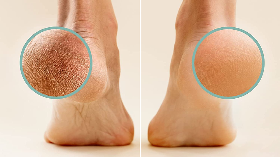 Lee Beauty’s Callus Remover For Feet Eliminates Dead Skin Fast