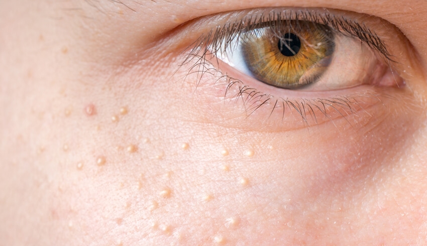 What Are Milia And How Do You Get Rid Of Them?